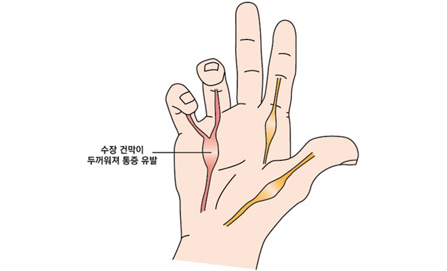 손가락듀피트렌구축증