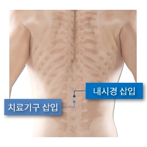 허리내시경