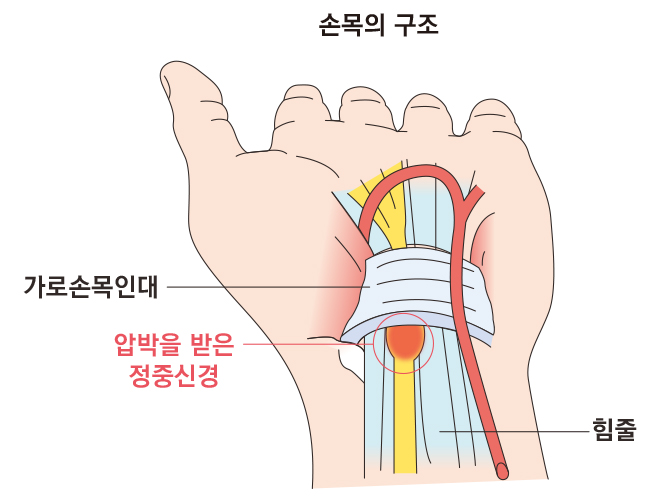 손목터널증후군